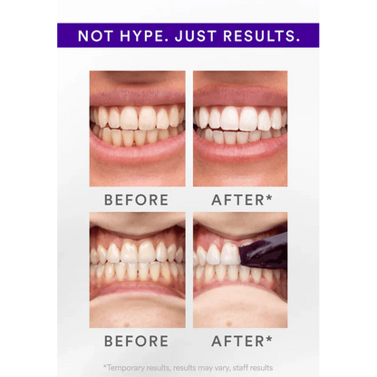 Purple Whitening Strips